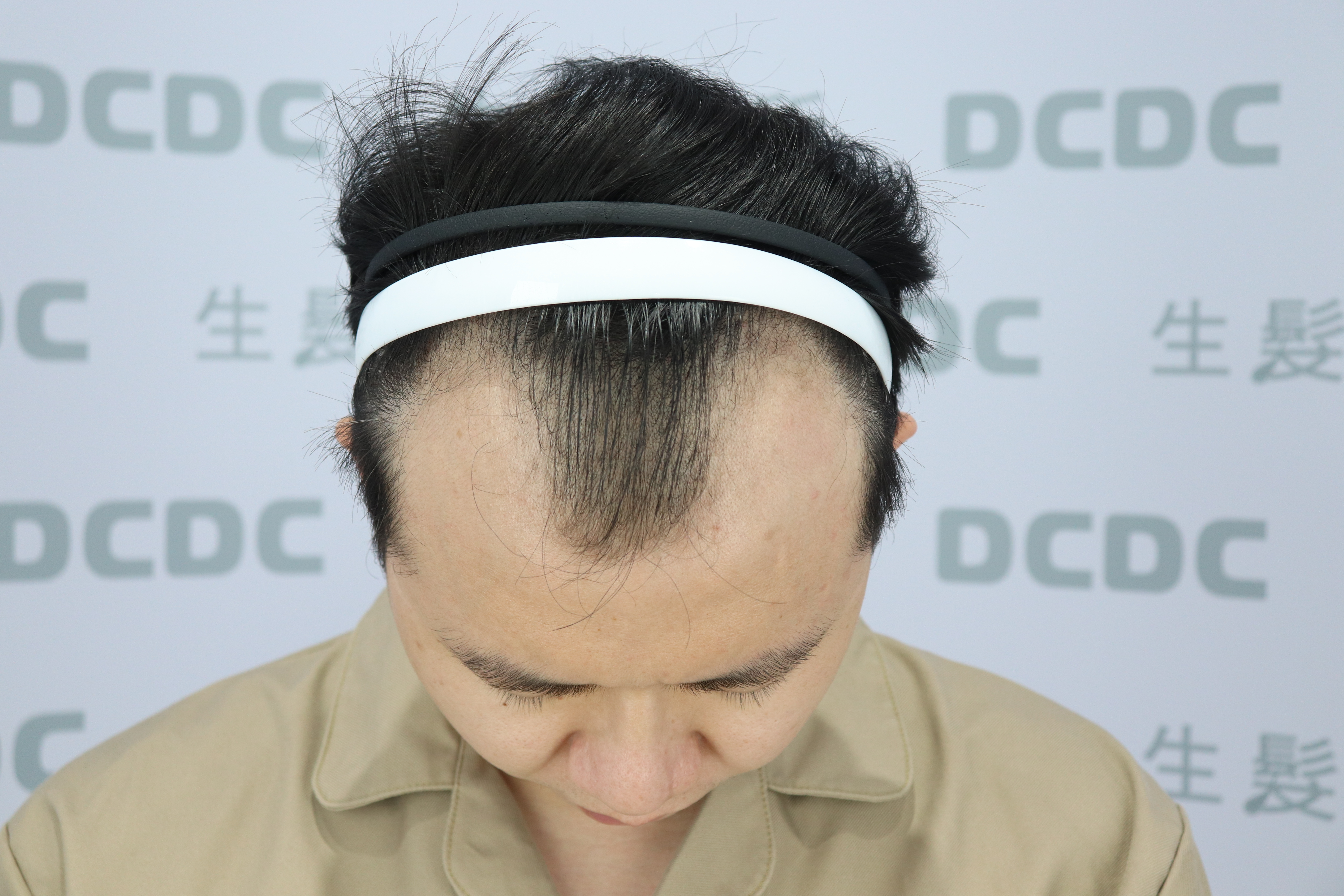 DCDC生髮診所-男性前額大面積掉髮與髮際線後退術前檢視
